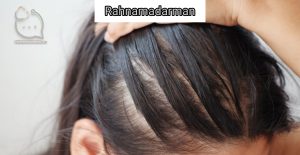 عکس ریزش مو بعد از عمل لاغری