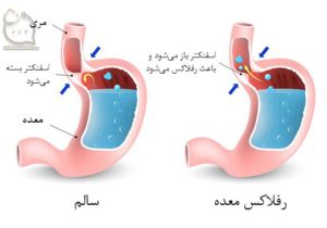 عکس رفلاکس نعده