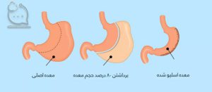 اسلیو معده با لاپاراسکوپی