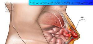 عکس فتق شکمی