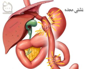 عکس نشتی معده