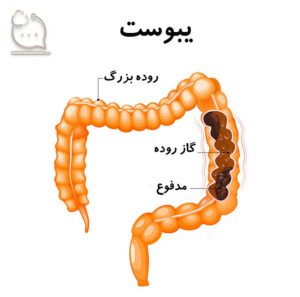 تصویر یبوست بعد از عمل لاغری