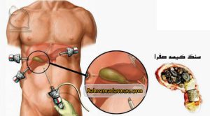 عکس سنگ صفرا بعد از عمل لاغری