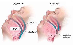 چاقی مفرط عوارض چاقی