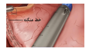 منگنه اسلیو