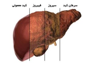 درمان فوری کبد چرب