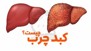 کبد چرب چیست درمان فوری کبد چرب