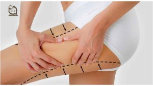 Slimming with the device