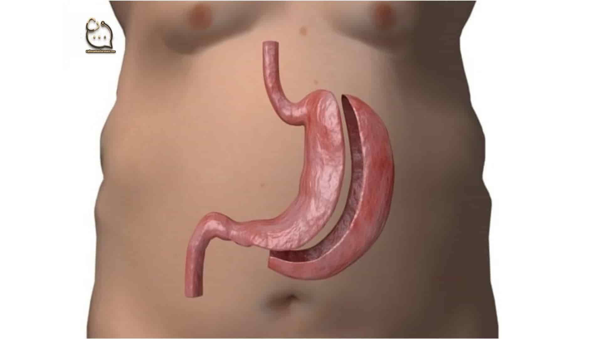 مراقبت بعد از عمل اسلیو معده