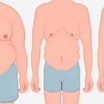 تکنیک های جلوگیری از افتادگی پوست بعد از عمل اسلیو