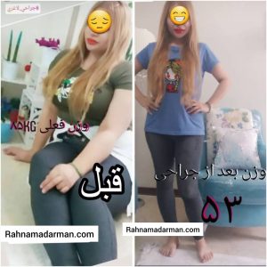 عکس قبل و بعد از عمل اسلیو معده