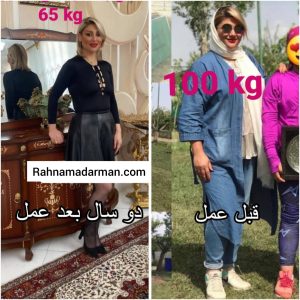 عکس قبل و بعد از عمل اسلیو معده