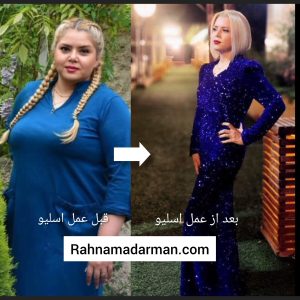 مشاهده عکس قبل و بعد از عمل اسلیو معده