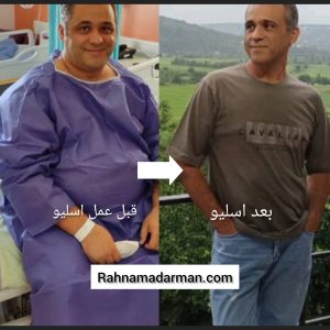 عکس قبل و بعد از عمل اسلیو معده