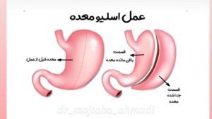 راهنمای تصویری فیلم عمل اسلیو معده