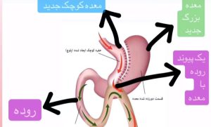 راهنمای تصویری عمل مینی بای پس معده