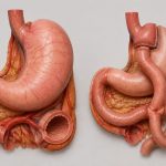 سخت‌ترین مرحله پس از بایپس معده (اعترافاتی از روی تجربه)