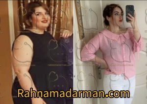 پس از بایپس معده 1