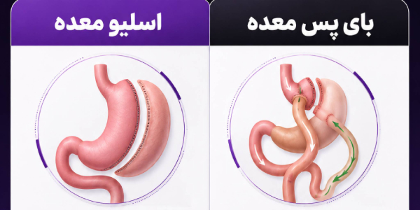 صفر تا صد پرسش و پاسخ های در مورد عمل اسلیو معده(در پنج دقیقه مطالعه کنید)+فیلم